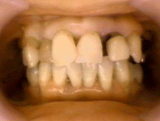 歯周外科治療　治療前