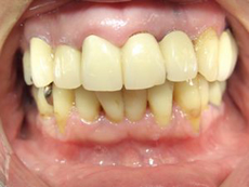 歯周外科治療　3年後