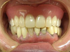 インプラント義歯治療前